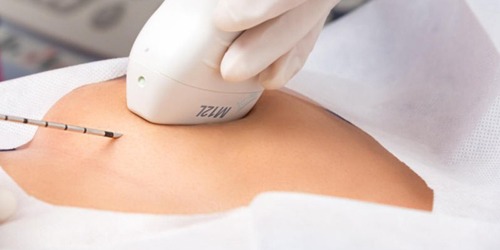 #JuevesDeSalud / 15.500 casos al año: el desafío del cáncer de mama y la urgencia de diagnósticos más certeros en Colombia